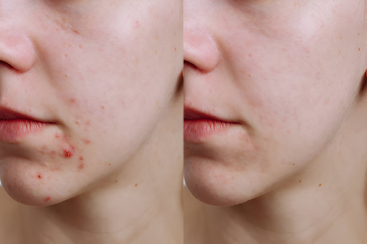 Acne b4 and after